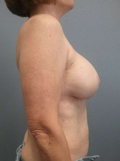 Breast Augmentation Revision (Breast Enlargement Repair) Before & After Patient #7314