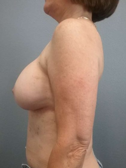 Breast Augmentation Revision (Breast Enlargement Repair) Before & After Patient #7314