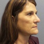 Rhinoplasty Before & After Patient #10219