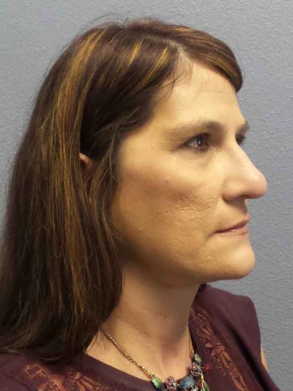 Rhinoplasty Before & After Patient #10219