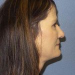 Rhinoplasty Before & After Patient #10219
