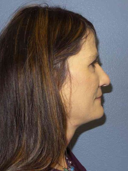 Rhinoplasty Before & After Patient #10219