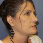 Rhinoplasty Before & After Patient #10219