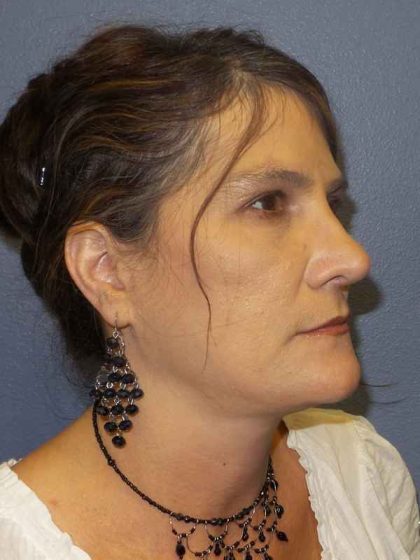 Rhinoplasty Before & After Patient #10219