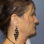 Rhinoplasty Before & After Patient #10219