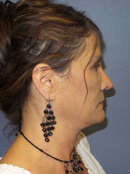 Rhinoplasty Before & After Patient #10219