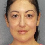 Liposuction of the Neck Before & After Patient #12115