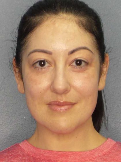 Liposuction of the Neck Before & After Patient #12115