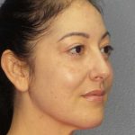 Liposuction of the Neck Before & After Patient #12115