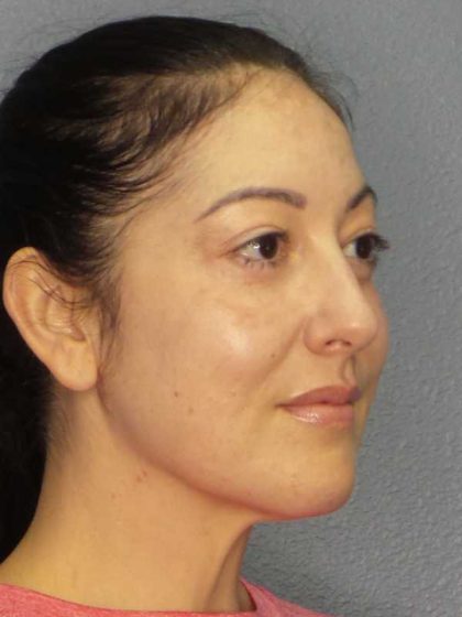 Liposuction of the Neck Before & After Patient #12115