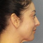 Liposuction of the Neck Before & After Patient #12115