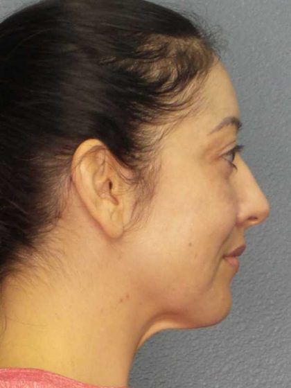 Liposuction of the Neck Before & After Patient #12115