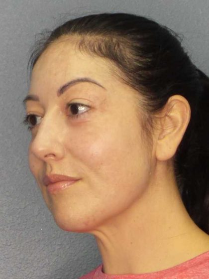 Liposuction of the Neck Before & After Patient #12115