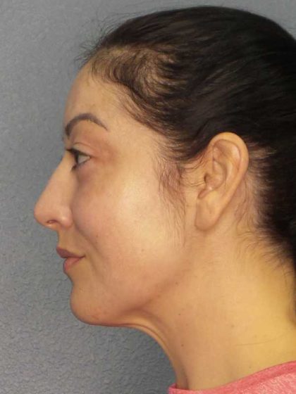 Liposuction of the Neck Before & After Patient #12115