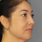 Liposuction of the Neck Before & After Patient #12115