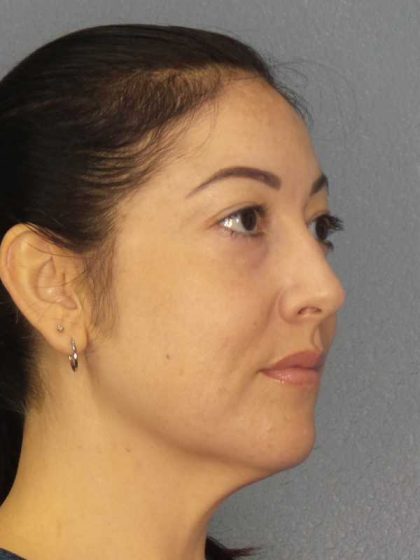 Liposuction of the Neck Before & After Patient #12115