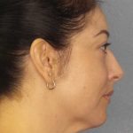 Liposuction of the Neck Before & After Patient #12115