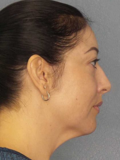 Liposuction of the Neck Before & After Patient #12115