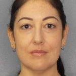 Liposuction of the Neck Before & After Patient #12115