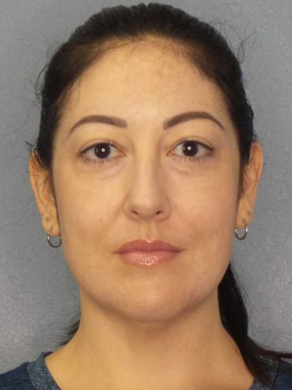 Liposuction of the Neck Before & After Patient #12115