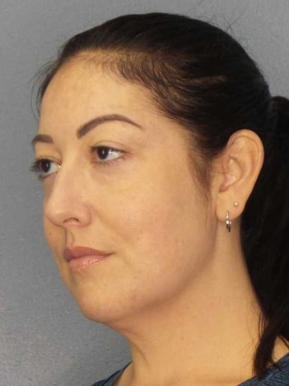 Liposuction of the Neck Before & After Patient #12115