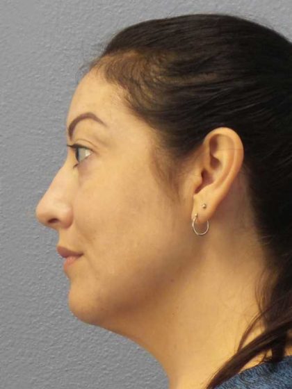 Liposuction of the Neck Before & After Patient #12115