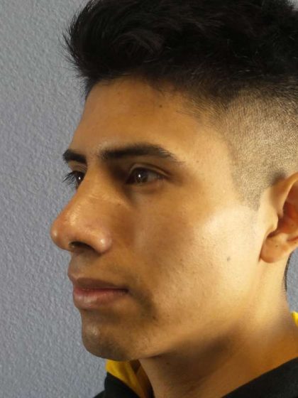 Rhinoplasty Before & After Patient #9929