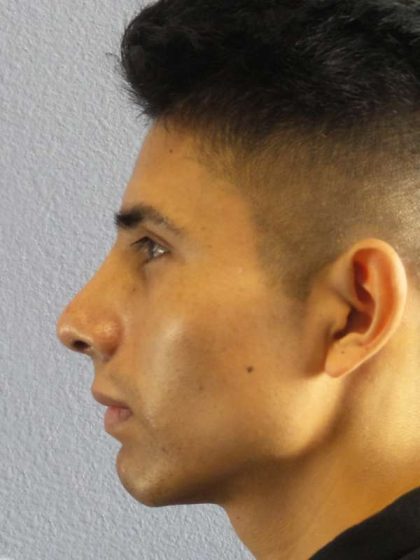 Rhinoplasty Before & After Patient #9929