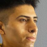 Rhinoplasty Before & After Patient #9929