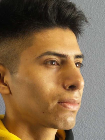 Rhinoplasty Before & After Patient #9929