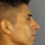 Rhinoplasty Before & After Patient #9929