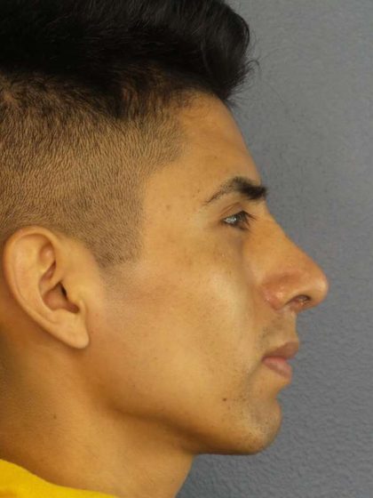 Rhinoplasty Before & After Patient #9929