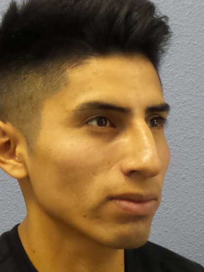 Rhinoplasty Before & After Patient #9929