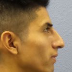 Rhinoplasty Before & After Patient #9929