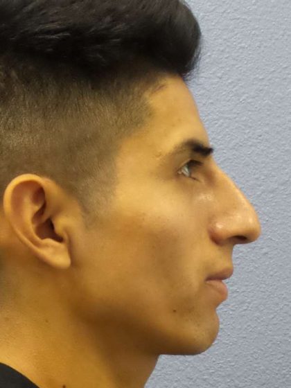 Rhinoplasty Before & After Patient #9929