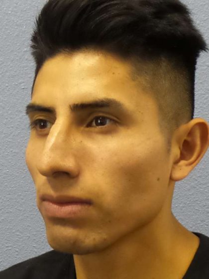 Rhinoplasty Before & After Patient #9929