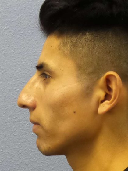 Rhinoplasty Before & After Patient #9929