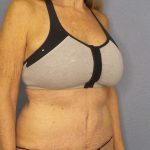 Abdominoplasty Before & After Patient #3610