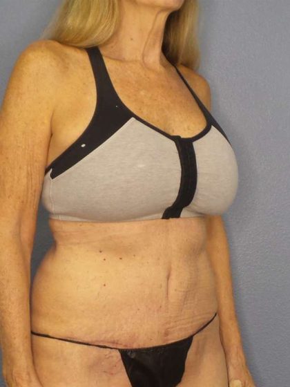 Abdominoplasty Before & After Patient #3610