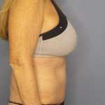 Abdominoplasty Before & After Patient #3610