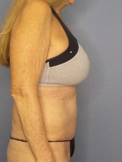 Abdominoplasty Before & After Patient #3610