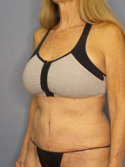 Abdominoplasty Before & After Patient #3610