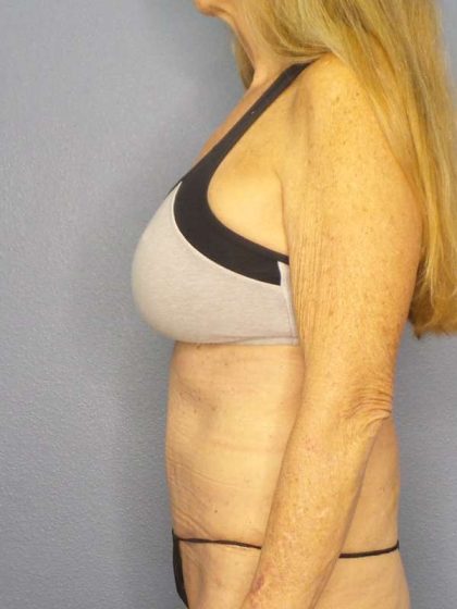 Abdominoplasty Before & After Patient #3610