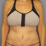 Abdominoplasty Before & After Patient #3610