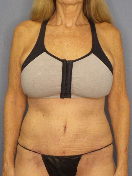 Abdominoplasty Before & After Patient #3610