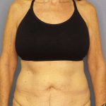 Abdominoplasty Before & After Patient #3610