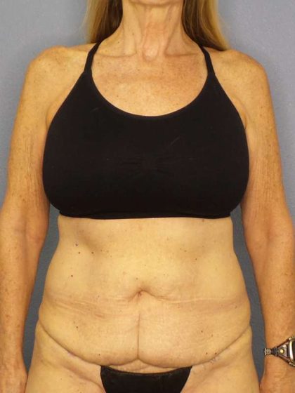Abdominoplasty Before & After Patient #3610