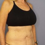 Abdominoplasty Before & After Patient #3610
