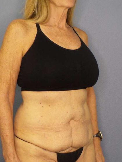 Abdominoplasty Before & After Patient #3610