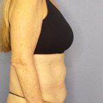 Abdominoplasty Before & After Patient #3610